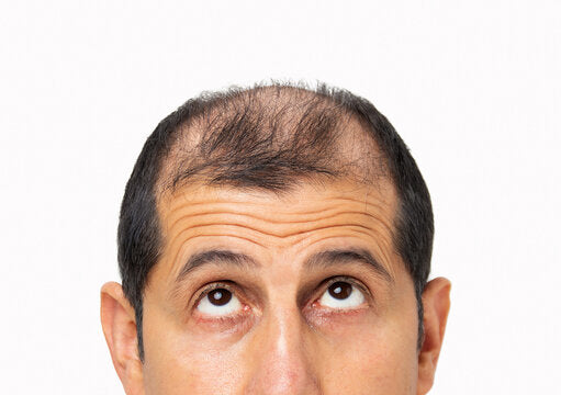 Balding man looking up at his thinning hair